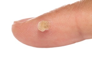 Bradavice - kožní onemocnění, se kterým účinně bojuje Skincell Pro