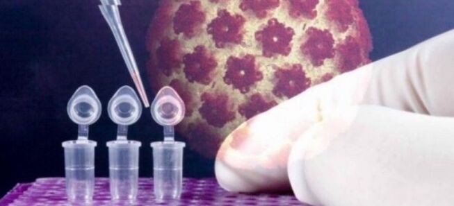 Diagnostika HPV pomocí testu digene